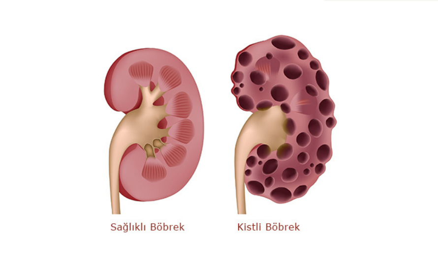 böbrek kisti