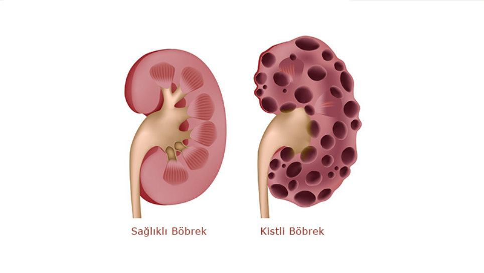 böbrek kisti