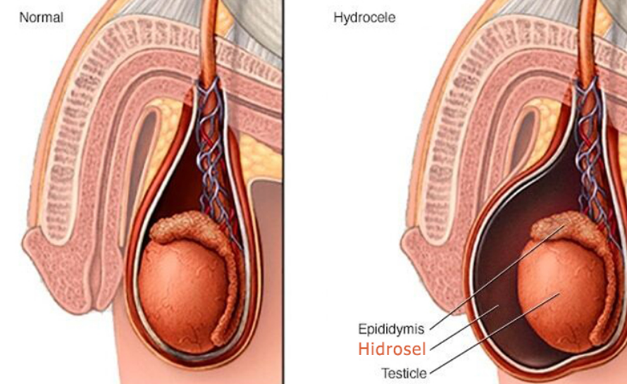 Hidrosel Nedir?