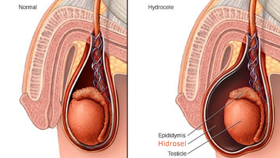 Hidrosel Nedir?