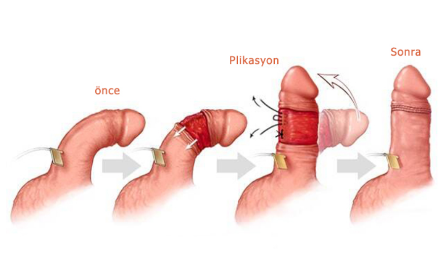 Penis Eğriliği Peyroni Hastalığı