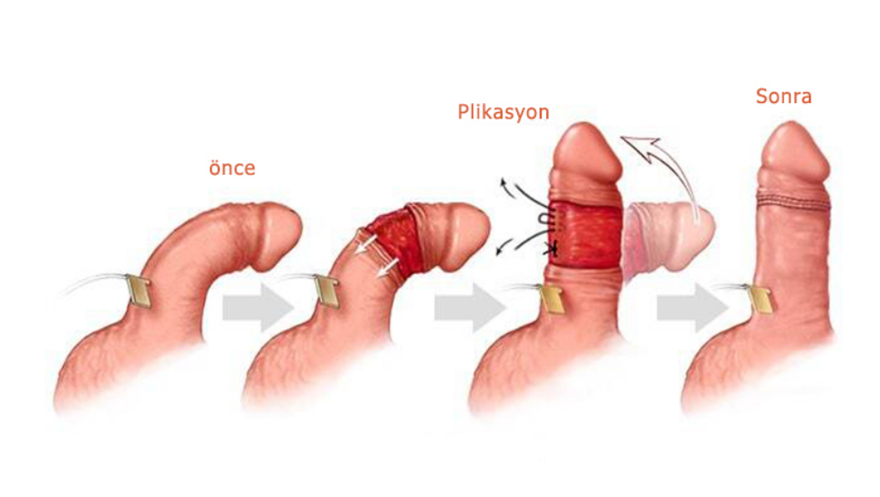 Penis Eğriliği Peyroni Hastalığı