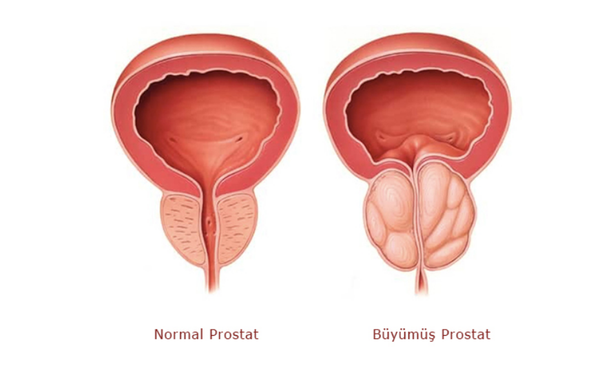 Prostat Büyümesi Nedir?