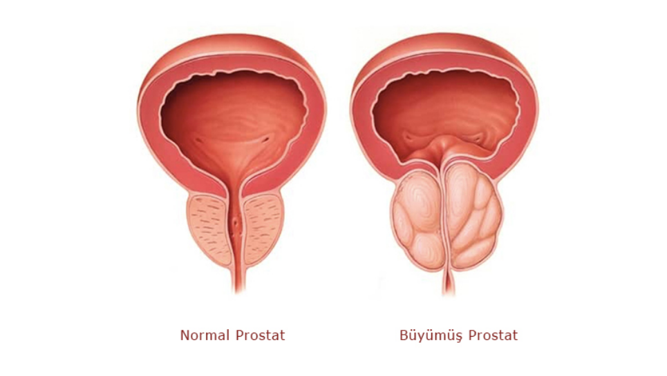 Prostat Büyümesi Nedir?