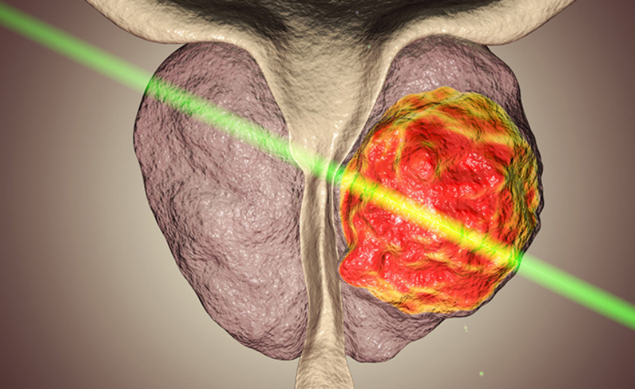 Prostat Büyümesi Tedavisinde Lazer Kullanımı