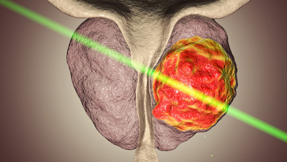 Prostat Büyümesi Tedavisinde Lazer Kullanımı