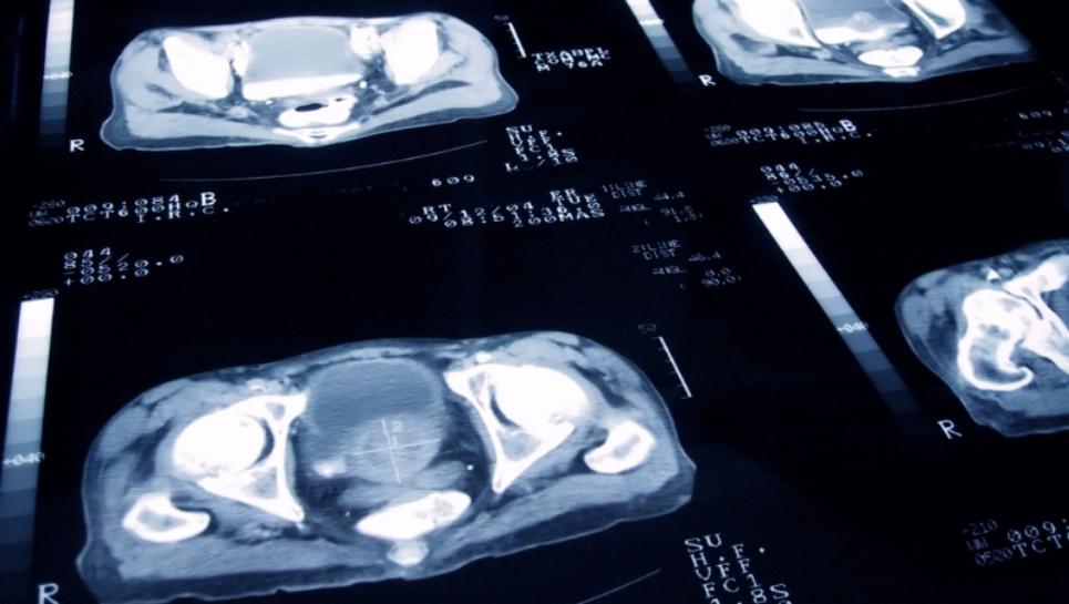 Prostat Kanserinde Multiparametrik MRI Kullanımı