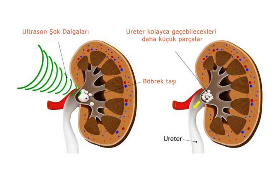 Şok Dalgalarıyla Taş Kırma (ESWL)