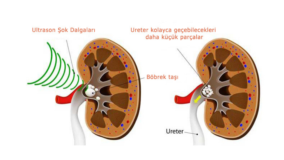 Şok Dalgalarıyla Taş Kırma (ESWL)