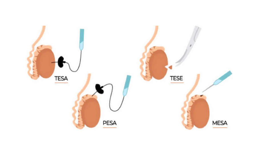 Sperm Elde Etme Yöntemleri ve Kısırlıkta Kullanımı