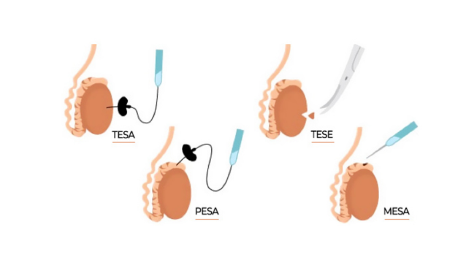 Sperm Elde Etme Yöntemleri ve Kısırlıkta Kullanımı