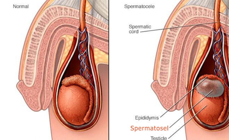 Spermatosel Nedir?