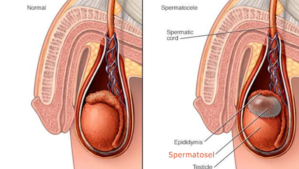 Spermatosel Nedir?