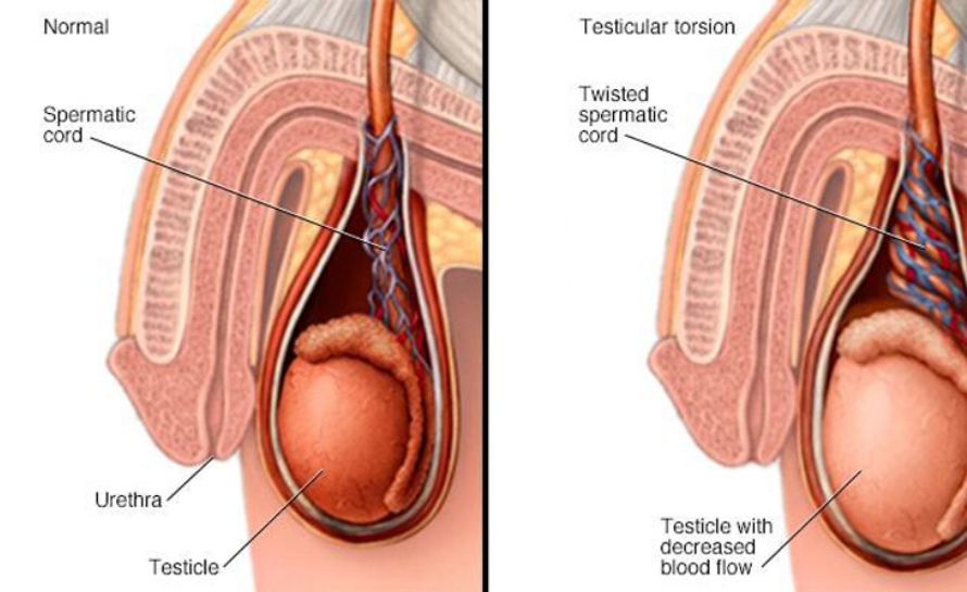 Testis Torsiyonu Nedir?