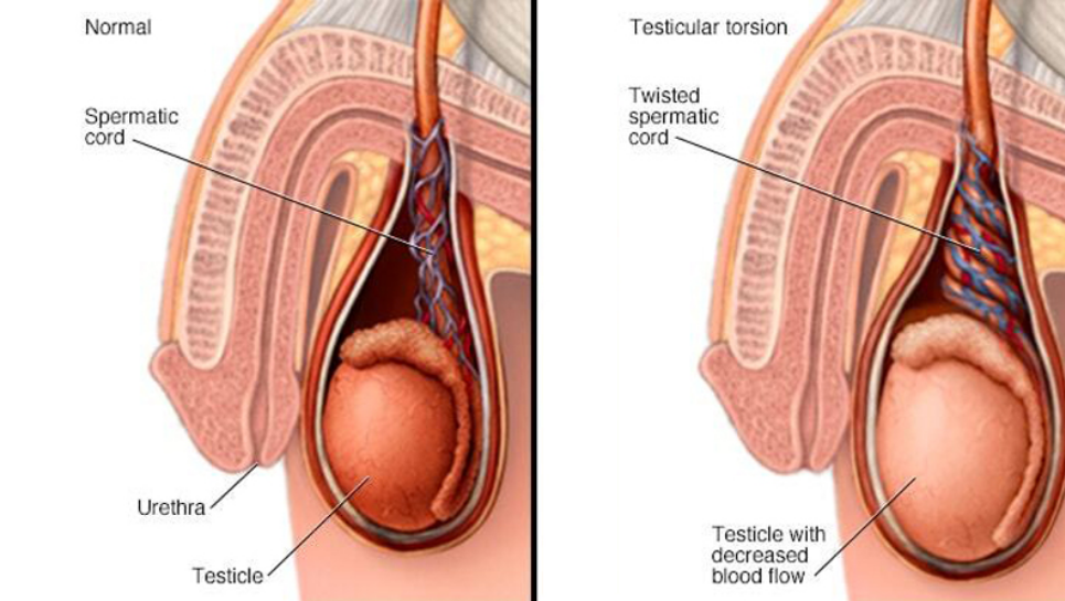 Testis Torsiyonu Nedir?