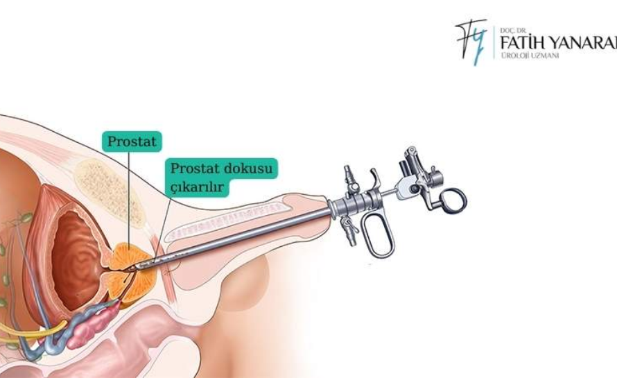 Transüretral Prostat Rezeksiyonu Nedir?