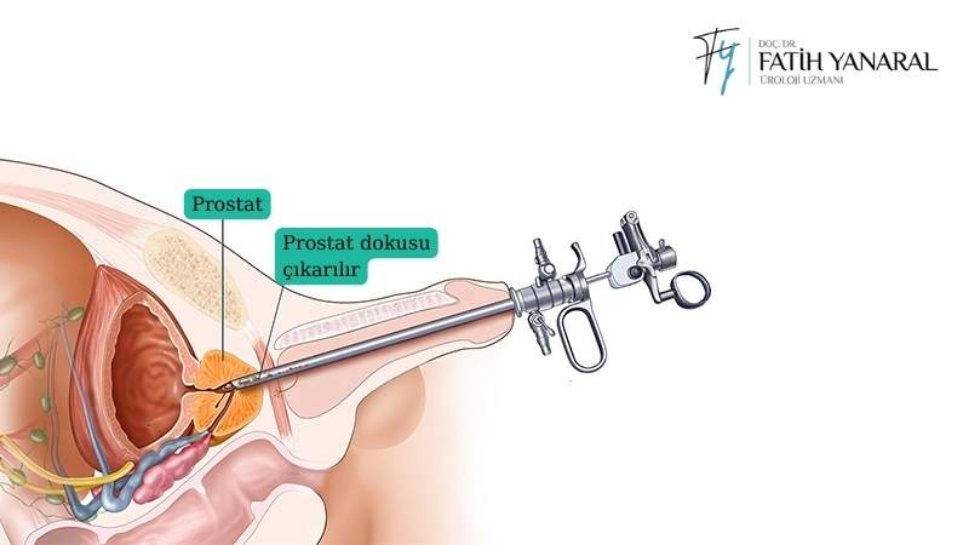 Transüretral Prostat Rezeksiyonu Nedir?