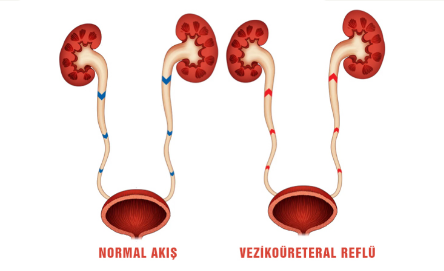 Vezikoüreteral Reflü