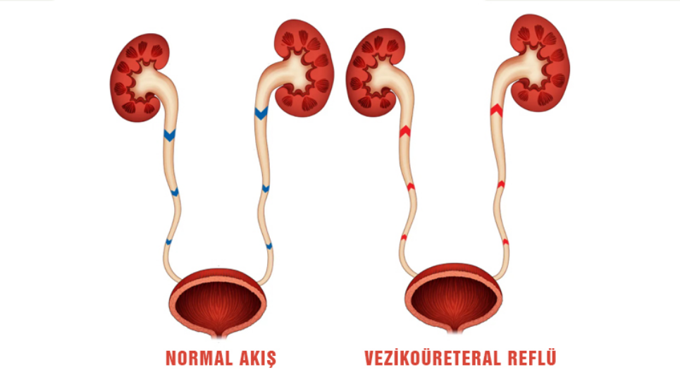 Vezikoüreteral Reflü