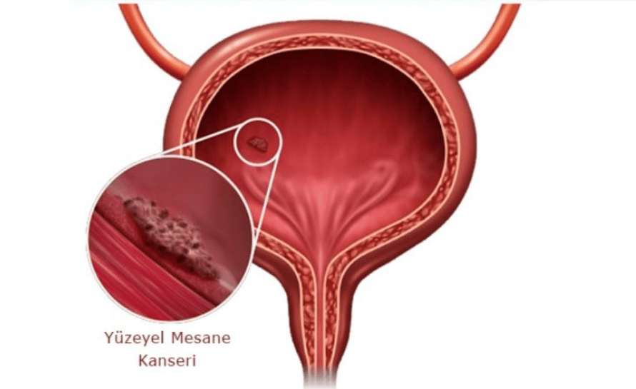 Yüzeysel Mesane Kanseri