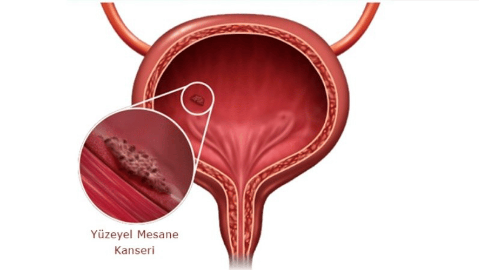 Yüzeysel Mesane Kanseri