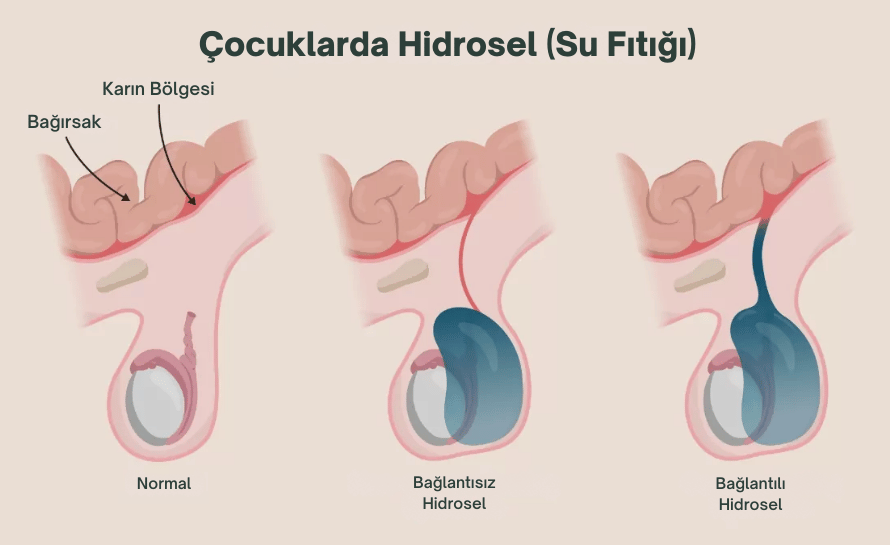 hidrosel