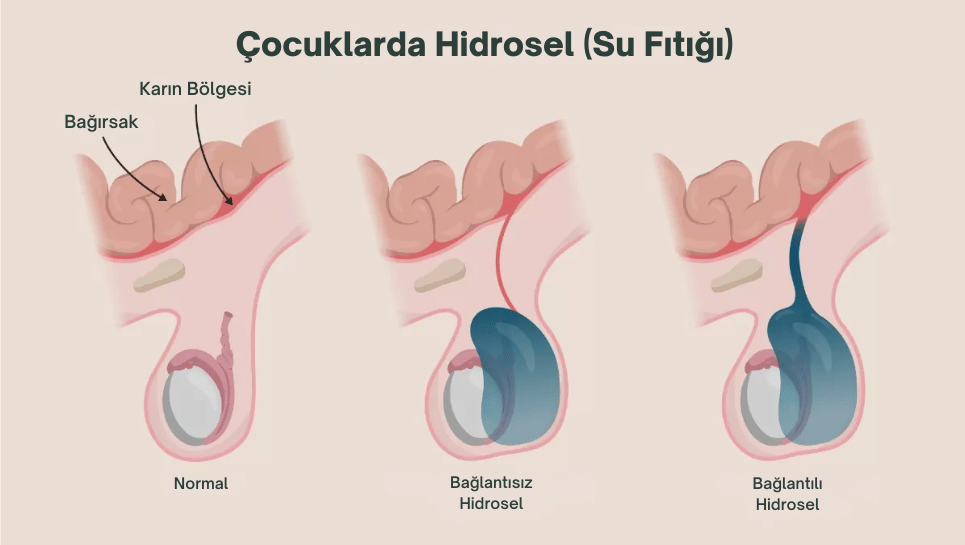 hidrosel