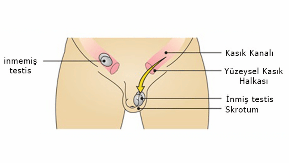 çocuklarda inmemiş testis