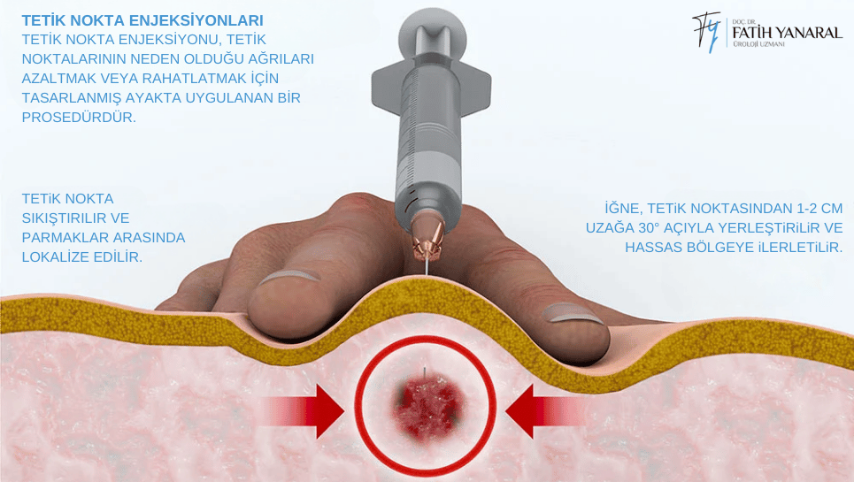 TETİK NOKTA ENJEKSİYONLARI