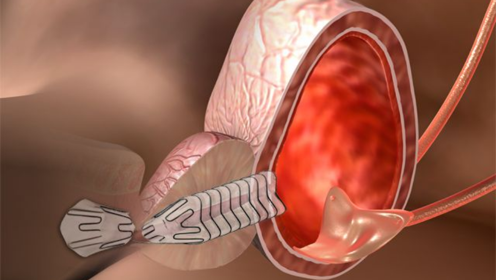 allium stent kullanımı