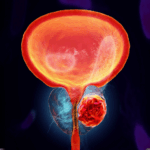 İnterstisyel Sistit ve Ağrılı Mesane Sendromu