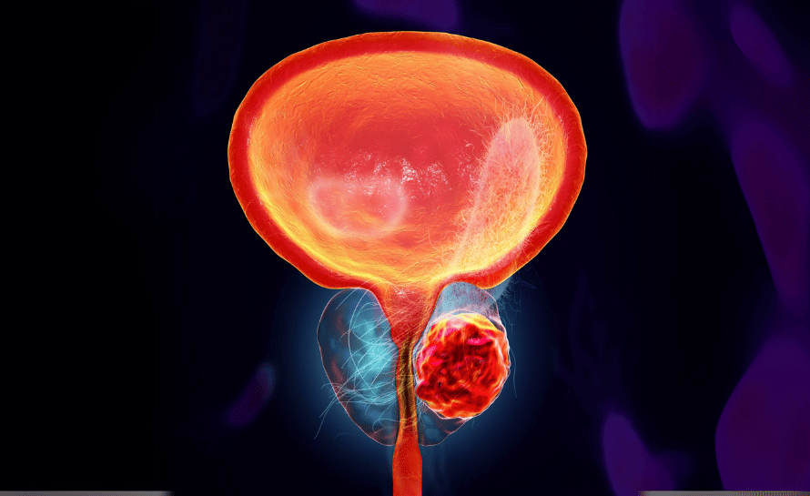 İnterstisyel Sistit ve Ağrılı Mesane Sendromu
