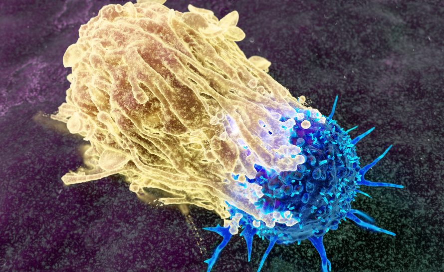 Kasa İnvaziv Mesane Kanserinde Mesane Koruyucu Tedavi 13 Kasa invaziv mesane kanseri