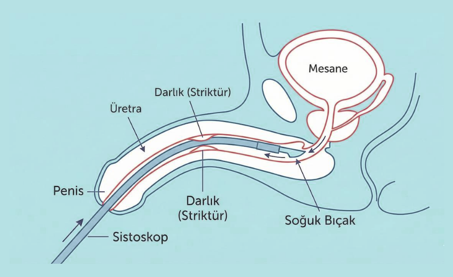 Tekrarlayan Üretra Darlığında Kesin Çözüm: Üretroplasti Ameliyatı Nedir? 13 Üretra darlığı tedavisinde kesin çözüm üretroplasti nedir