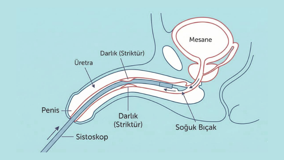 Tekrarlayan Üretra Darlığında Kesin Çözüm: Üretroplasti Ameliyatı Nedir? 2 Üretra darlığı tedavisinde kesin çözüm üretroplasti nedir